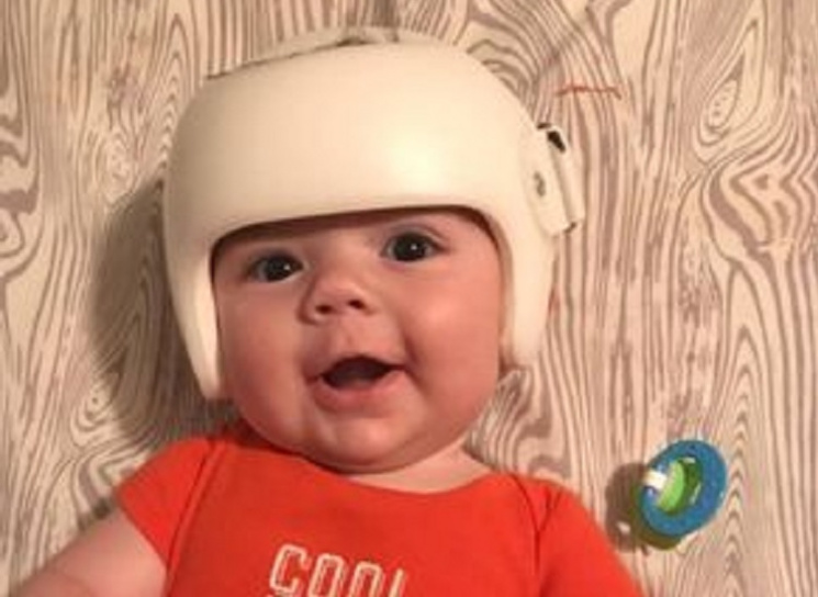  The Family Wears Helmets At All Times To Make The Sick Baby Feel Comfortable